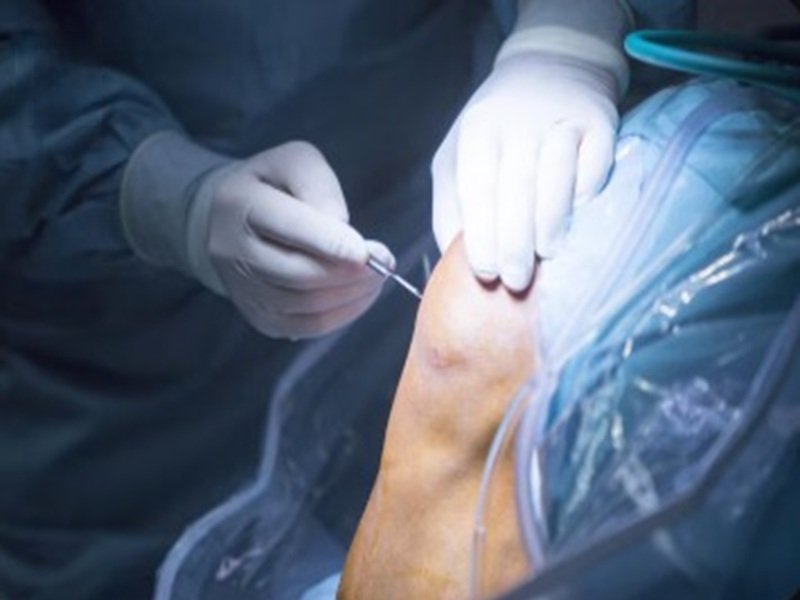 Arthroscopy Surgery